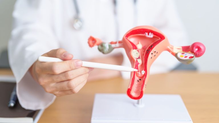 Memahami Kista Ovarium pada Wanita: Definisi, Gejala, Dampak, dan Solusi Penanganan untuk Rahim yang Kembali Sehat